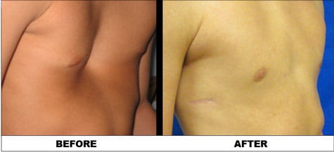 Pectus patient (16 years old)  before surgery and after surgery photo.